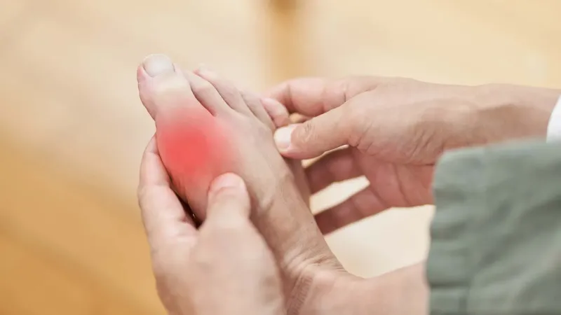 Pied avec goutte - Gout foot