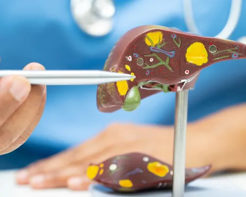 Prévenir et renverser la stéatose hépatique non alcoolique A doctor is using a stethoscope to examine a model of a liver.