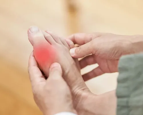 Pied avec goutte - Gout foot