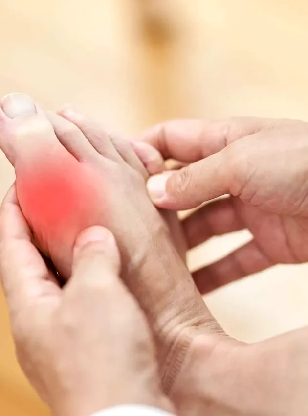 Pied avec goutte - Gout foot
